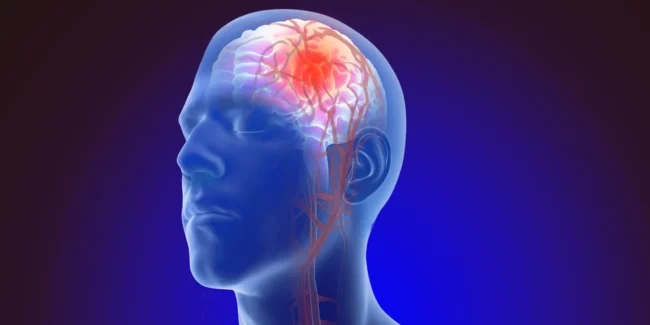 Cerebral Brain Anuerysm